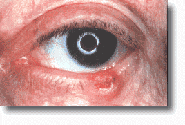 Tumor Eyelid